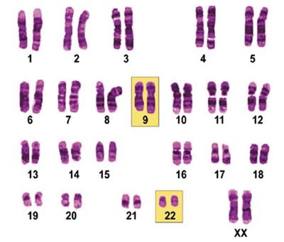 Chronische myeloische Leukämie (CML): Das Philadelphia-Chromosom