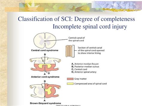 Ppt Traumatic Spinal Cord Injury Powerpoint Presentation Free