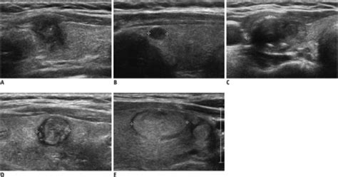 Five Categories For Us Diagnosis Of Solid Thyroid Nodul Open I