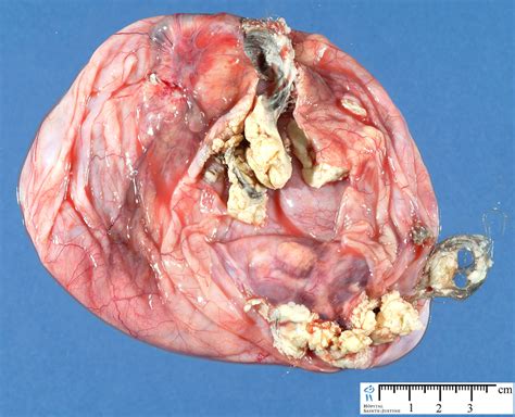 Ovarian Dermoid Cyst Human Pathology