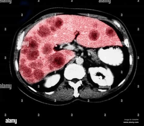 Ct Scan Slices Showing Extensive Metastatic Liver Cancer Stock Photo