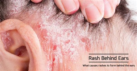 Rash Behind The Ear Causes And Other Symptoms Of Rash On Neck And Ears