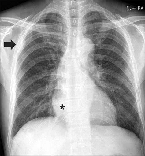 Chest Radiography Showed A Well Defined Nodular Opacity In Right Upper