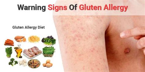 We did not find results for: 7 Sure Signs That You Have a Gluten Allergy