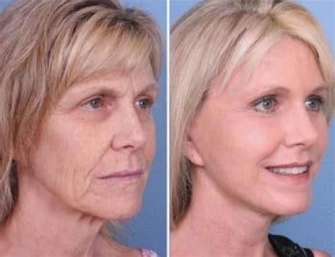 Conduct Your Own Facelift Without Surgery Via Facelift Yoga Workouts