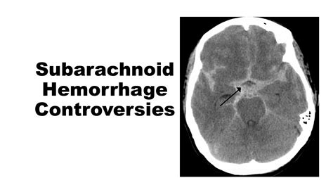 Subarachnoid Hemorrhage In Newborns Subarachnoid Hemo Vrogue Co