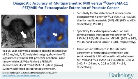 Diagnostic Accuracy Of Multiparametric Mri Versus Ga Psma Pet Mri For Extracapsular