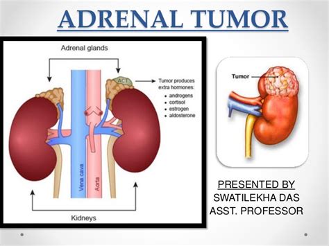 Adrenal Tumor Classification Management Easy Explanation