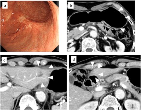 Esophagogastroduodenoscopy Egd And Computed Tomography Ct Findings