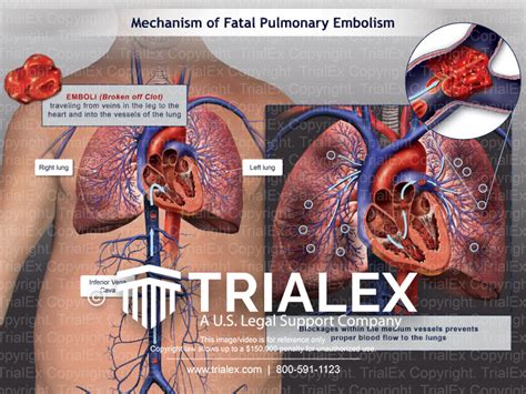 Mechanism Of Fatal Pulmonary Embolism Trialexhibits Inc