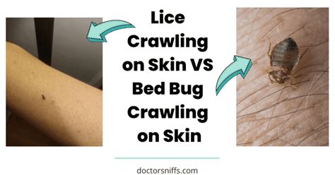 Lice Vs Bed Bugs Ultimate Guide With Photos