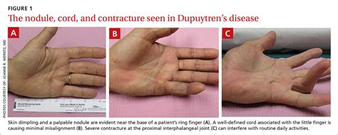 What Causes Dupuytrens Disease