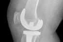 Check spelling or type a new query. How to Remove Scar Tissue From the Knee After Surgery ...