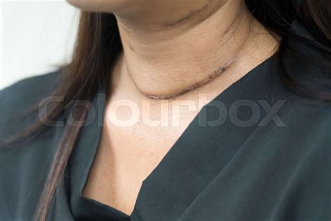Post Surgical Scar On Woman Neck After Thyroid Surgery Stock Image