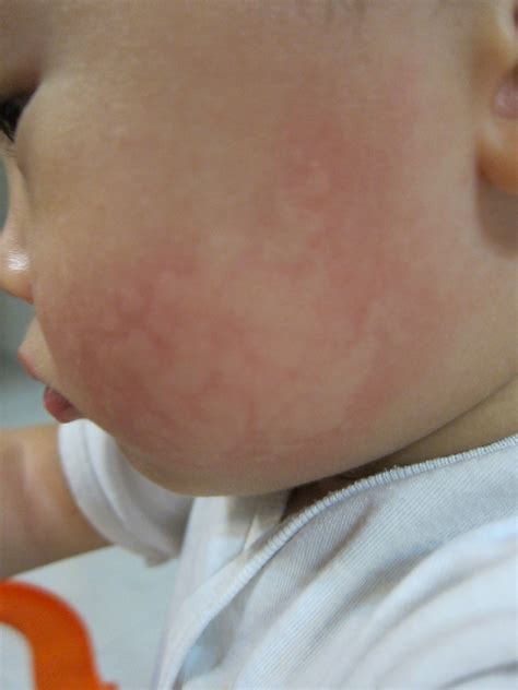 Allergic Skin Reaction Medical Pictures Info Health Definitions Photos