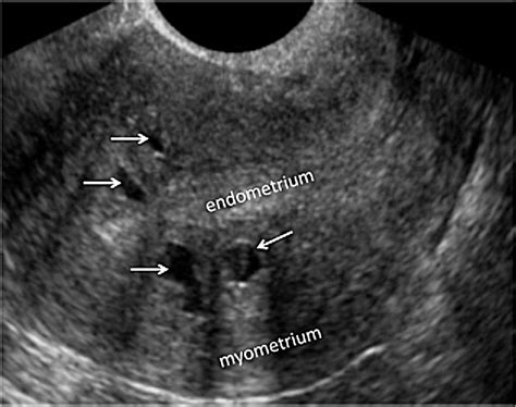 Pdf Imaging For The Evaluation Of Endometriosis And Adenomyosis