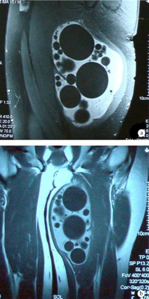 Photograph Of Excised Hydatid Cyst Shows The Numerous Daughter Cysts