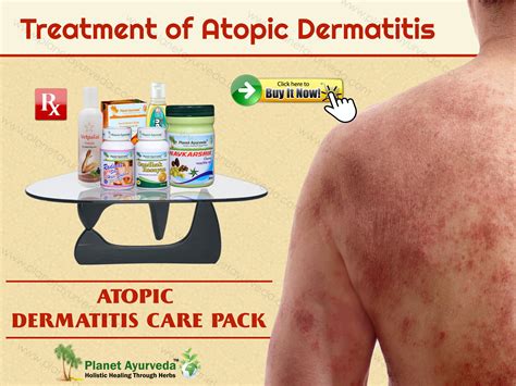 Treatment Of Atopic Dermatitis With Natural Herbal Remedies