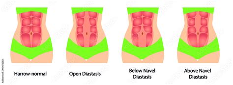 Diastasis Illustration Different Types Of Diastasis Abdomen Wall