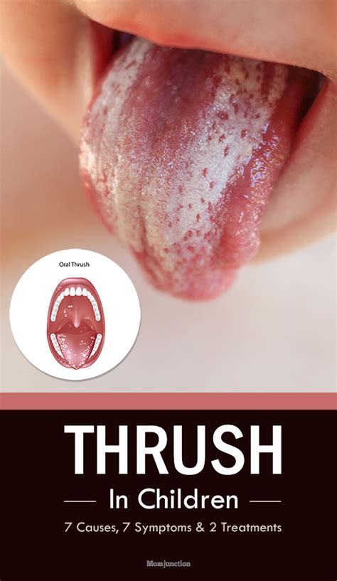 Thrush In Children Symptoms Causes And Treatment