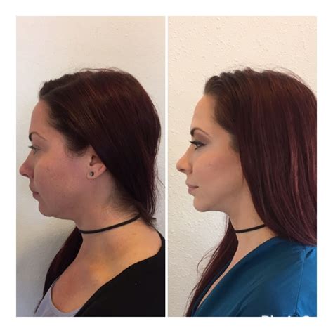 Kybella And Syringe Of Voluma In The Jawline Cheek Fillers Facial