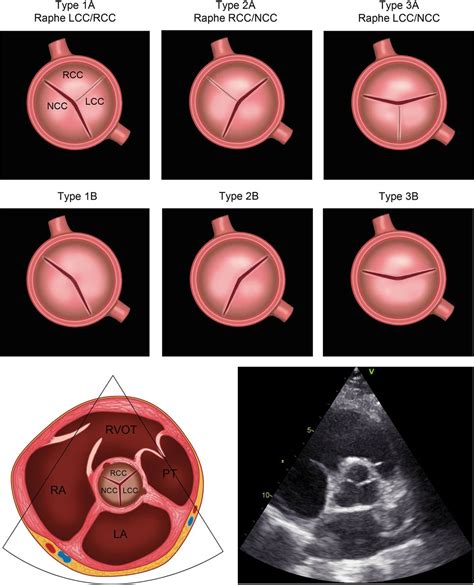 Coronary Anatomy As Related To Bicuspid Aortic Valve Morphology Heart
