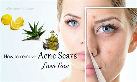 31 Ways How To Remove Acne Scars From Face Fast At Home