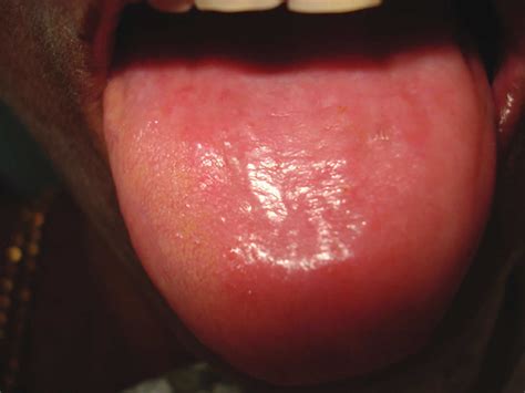 Smooth tongue, causes, symptoms, diagnosis & treatment