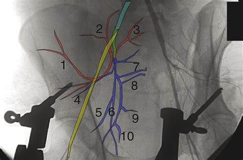 Angiography And Embolization In The Management Of Bleeding P Jaaos