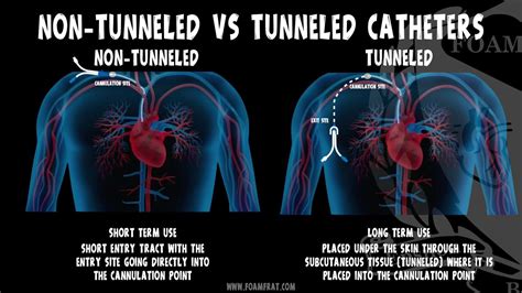 Foamfrat Non Tunneled Vs Tunneled Catheters