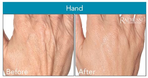 Radiesse Hand Rejuvenation Skinpossible Calgary Laser Clinic