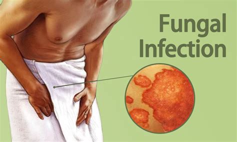 Fungal Infection Treatment In Surat Gujarat India