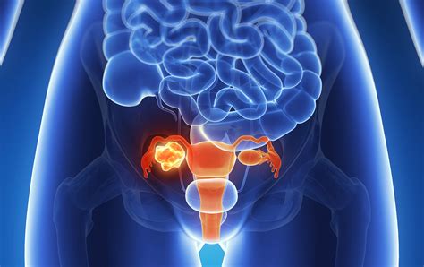 Ovarian Tumor Sidedness Not Associated With Prognosis Cancer Therapy