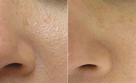 Large Pores Dull Dry Skin Dtox Medispa