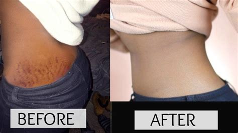 The Stretch Mark Solution Rapidly Erase Them At Home With Diy Natural Methods Youtube