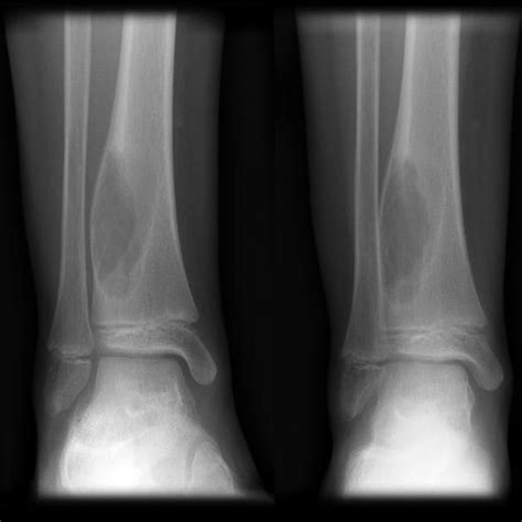 Aneurysmal Bone Cyst Abc Radiology Case