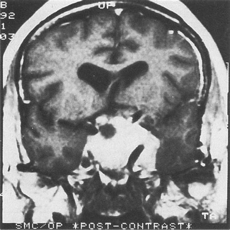 Frontal Lobe Tumor Patient 3 Was Profoundly Depressed Preoperatively