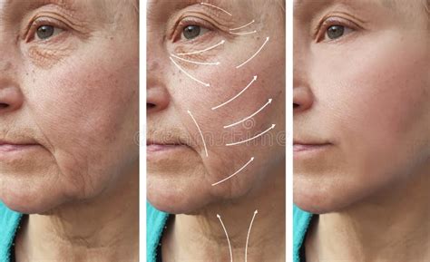 Corrección Facial De Las Arrugas De La Mujer Antes Y Después De La