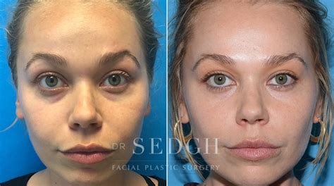 Wrinkle Relaxers Before And After Photos Dr Sedgh