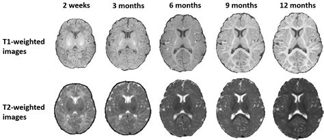 Miccai Grand Challenge On 6 Month Infant Brain Mri Segmentation