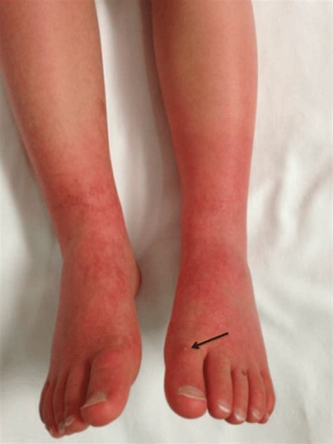 Photograph Of The Lower Extremities Of Patient 1 With Primary Em Note