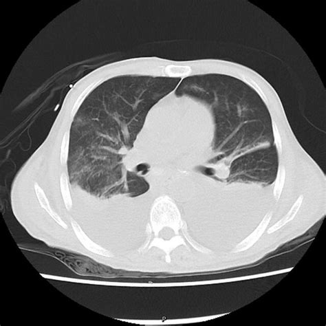 The Chest Computed Tomography Imaging During Disease Progression