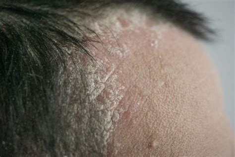 Psoriasis Or Dandruff Symptoms Treatment And Tips