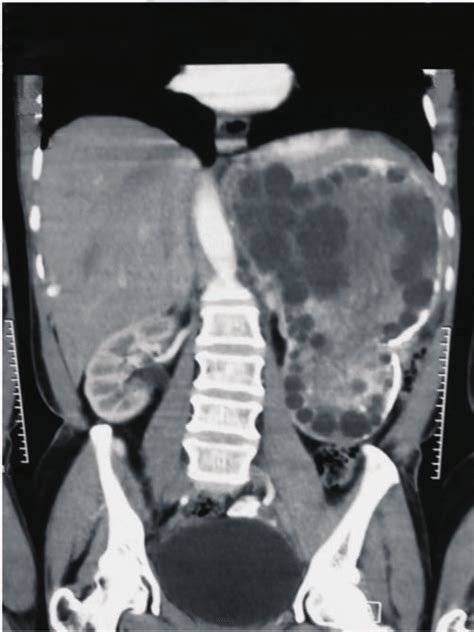Ct Abdomen Showing Enlarged Spleen Due To Hydatid Cyst With Multiple