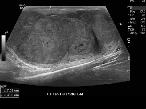 Testicular Seminoma Ultrasound