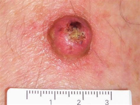 Skin Cancer Pictures Most Common Skin Cancer Types With Images