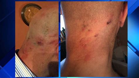 Young Adults Share Shingles Symptoms With Photos Of Rashes
