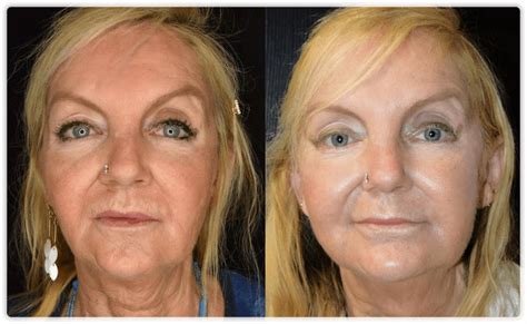 Thread Lift Face Lift Procedures In Toronto And Mississauga Lip Doctor