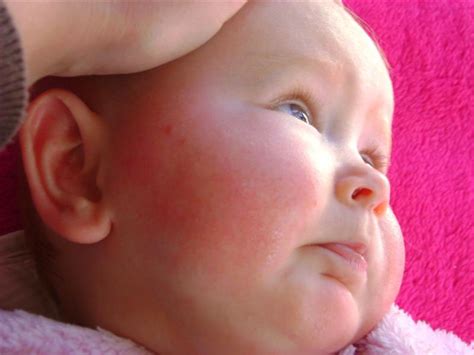 Baby Rash On Face Common Causes And Possible Treatments