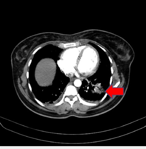 Ct Pulmonary Angiography Showing Pulmonary Infarction Ct Computed